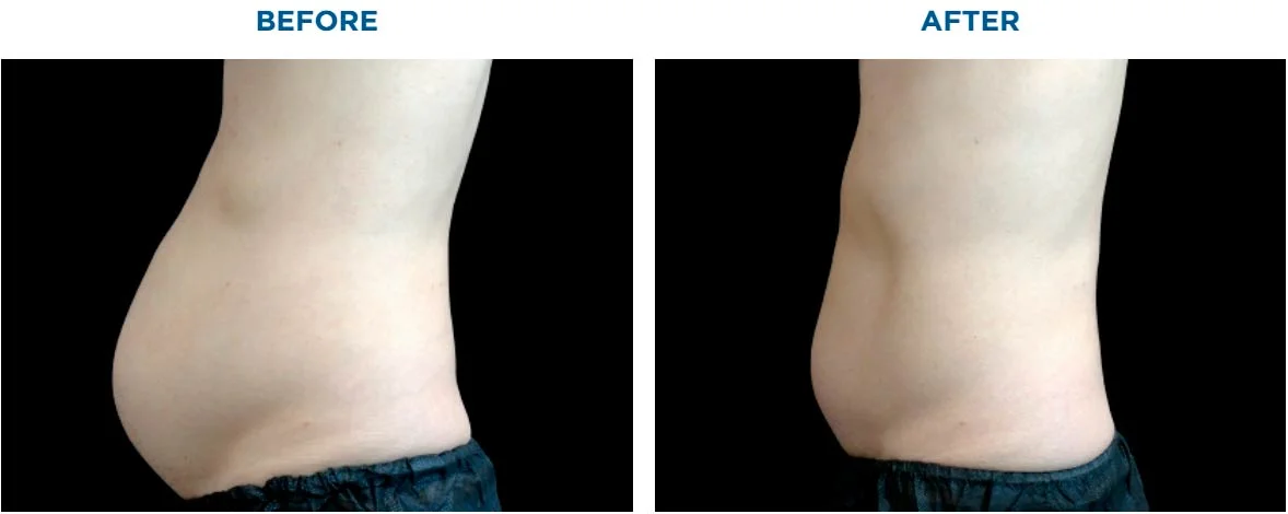 EMSCULPT-before-after-3