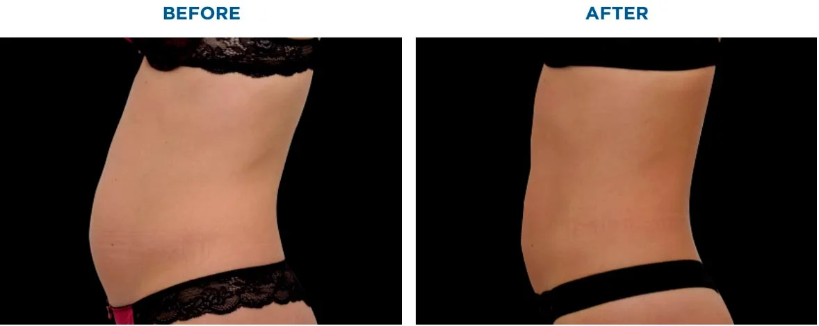 EMSCULPT-before-after-4