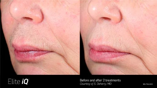 alite-before-after-4