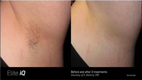 alite-before-after-5